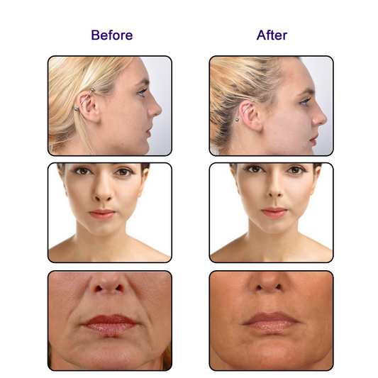 Auro PDO Mono Thread For Face and Body Lift