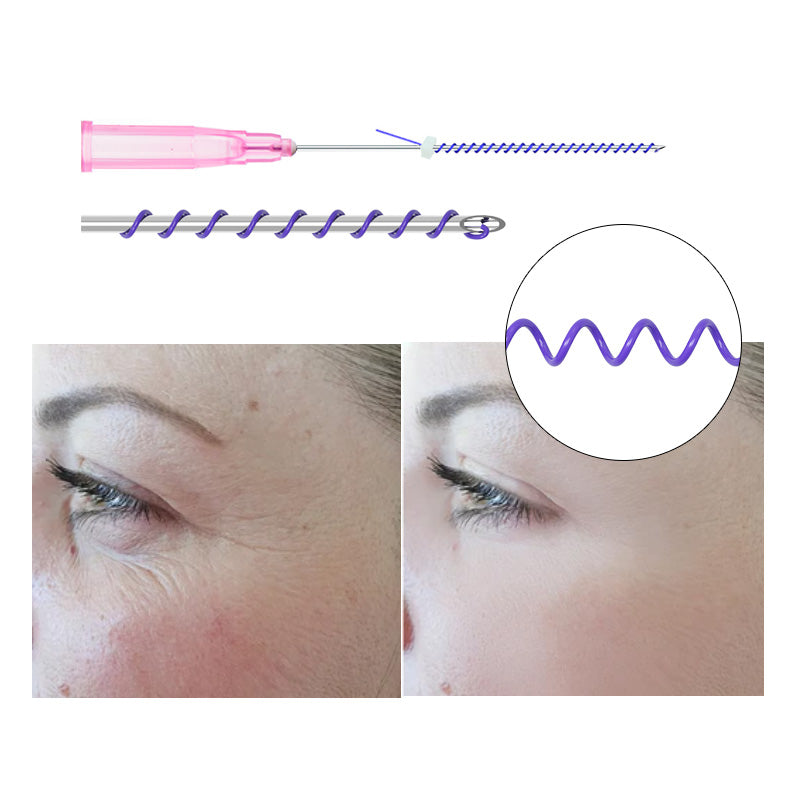 Deenora PDO Mono Screw Thread Lifting For Face Sharp Needle