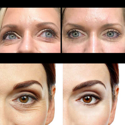 Auro PDO Eye thread Reduces Dark Circles Eye Bags And Crow's Feet