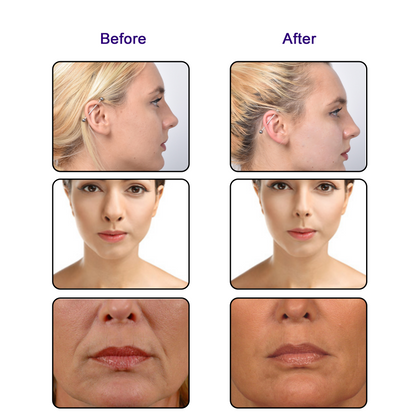 Auro PDO Mono Thread For Face and Body Lift