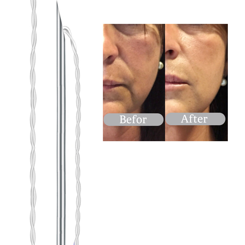 Deenora PCL Tornado Thread Effectively Lifts Facial Contours