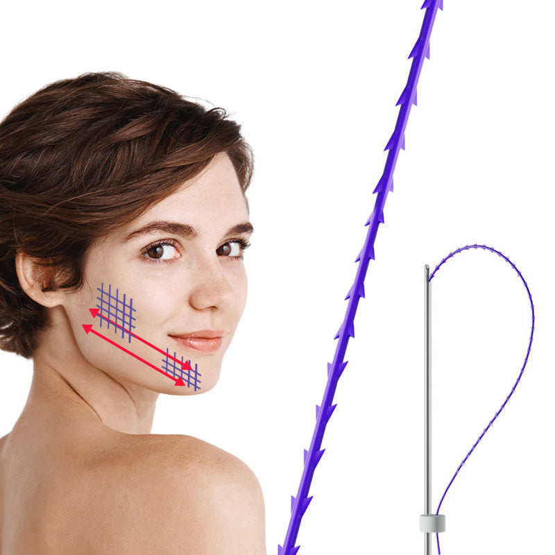 Deenora Pdo Fishbone  Threads  For Body Lift Long Lasting 20pcs